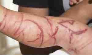 Chironex fleckeri box jellyfish sing marks on a child’s leg
